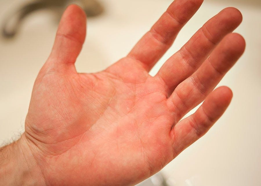 มือแดงบวม